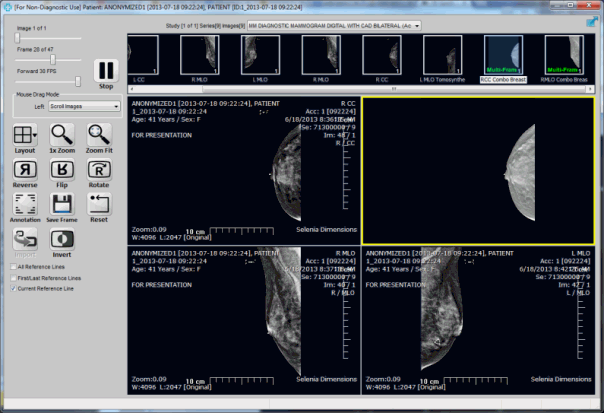 Tomosynthesis study